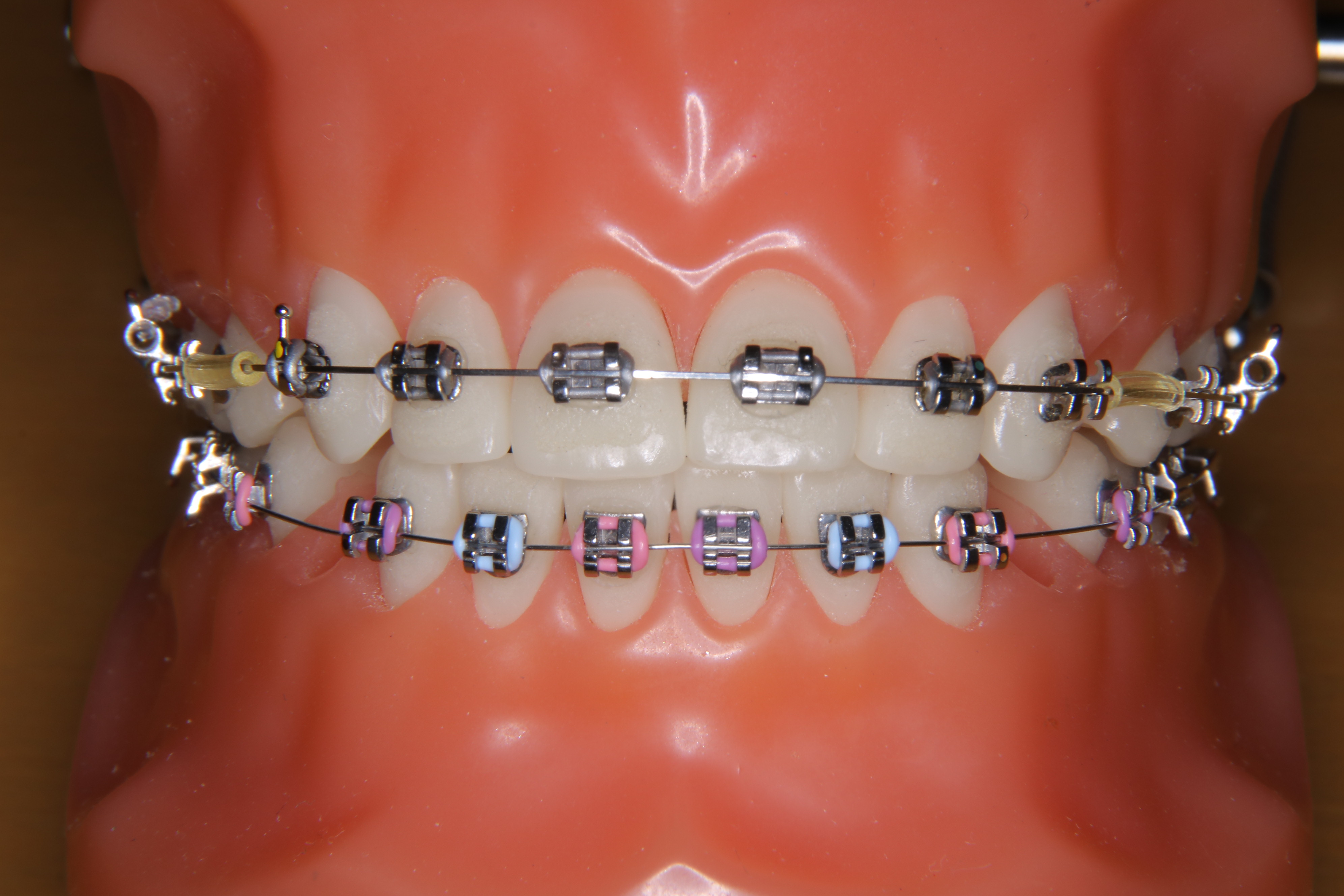 【コスプレ用】矯正ブラケット ブラケットの種類 - あかつき矯正歯科クリニック