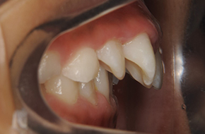 8 12歳のお子さんの矯正治療 あかつき矯正歯科クリニック